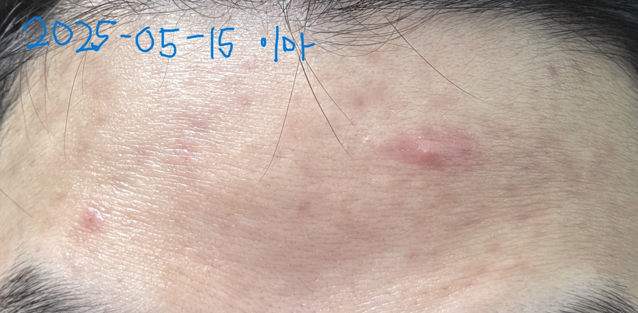 라비드 사용 2개월 2차 솔직 후기(단단이)